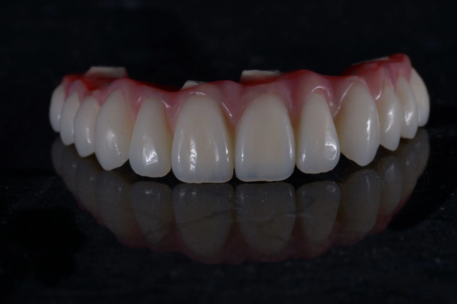 Ergebnis der festsitzenden Arbeit auf 6 Implantaten – Nahaufnahme