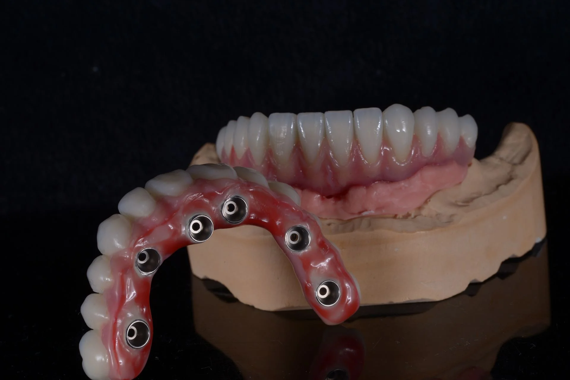 Implantatgetragene Brücke – Modell mit 6 Implantaten im Oberkiefer